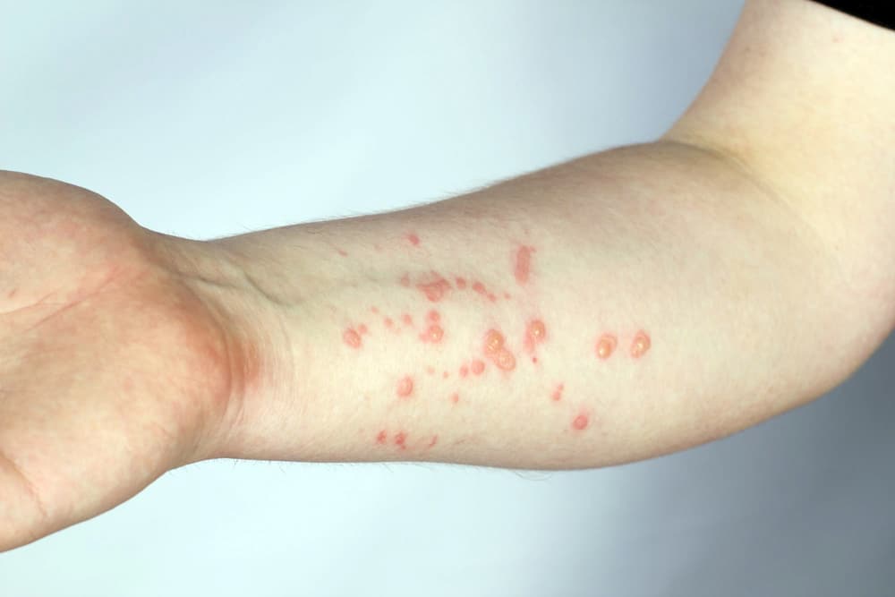 جدري القرود