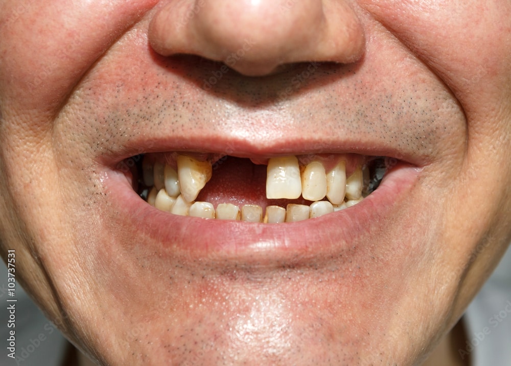 حلم سقوط الأسنان